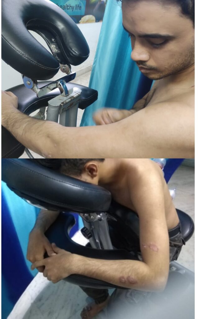 Treatment of Psoriasis through Cupping Therapy (Hijama)